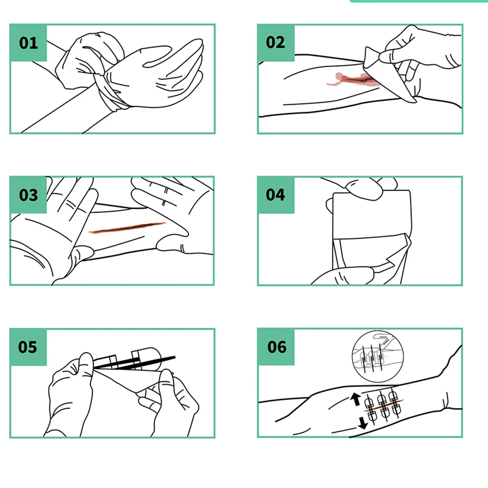 RHINO RESCUE Zip Stitch 6pcs with Wound Dresssings, Wound Closure Strips, Zipstitch Laceration Closure Kit for Cut Care Band-aid